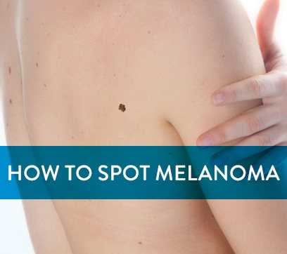 How to Spot Melanoma